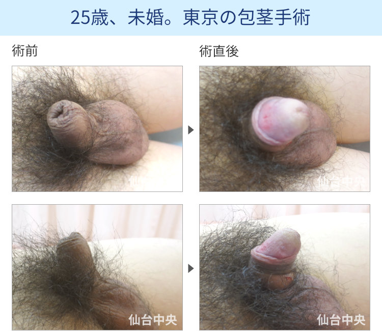 30歳、未婚。東京の茎手術、切らない包茎手術