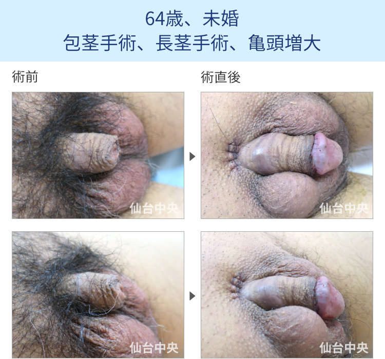 64歳、未婚。包茎手術、長茎手術、亀頭増大