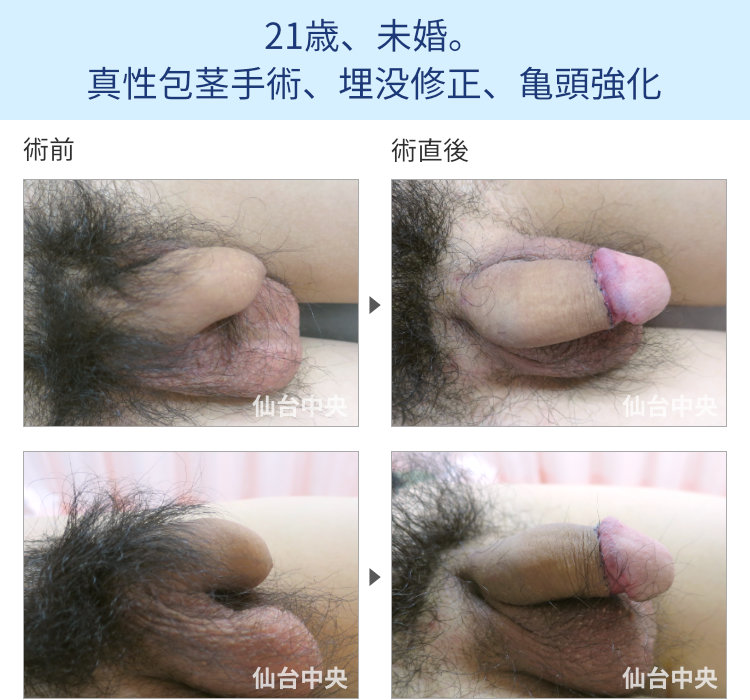 21歳、未婚。真性包茎手術、埋没修正、亀頭強化