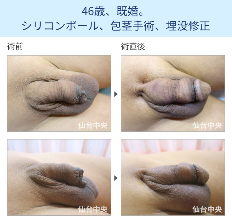 46歳、既婚。シリコンボール、包茎手術、埋没修正