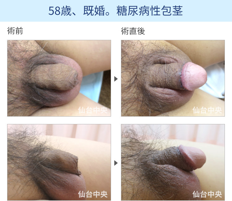 58歳、既婚。糖尿病性包茎