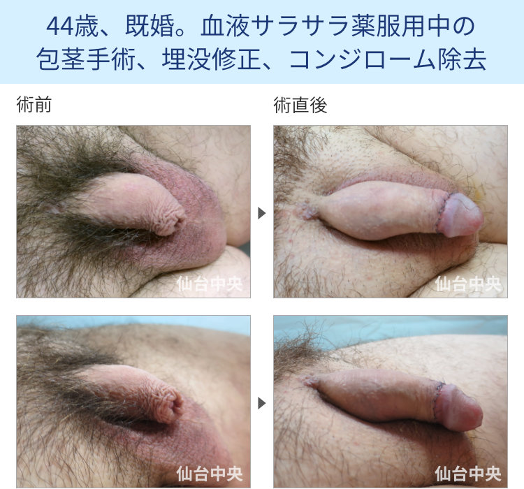 44歳、既婚。血液サラサラ薬服用中の包茎手術、埋没修正、コンジローム除去