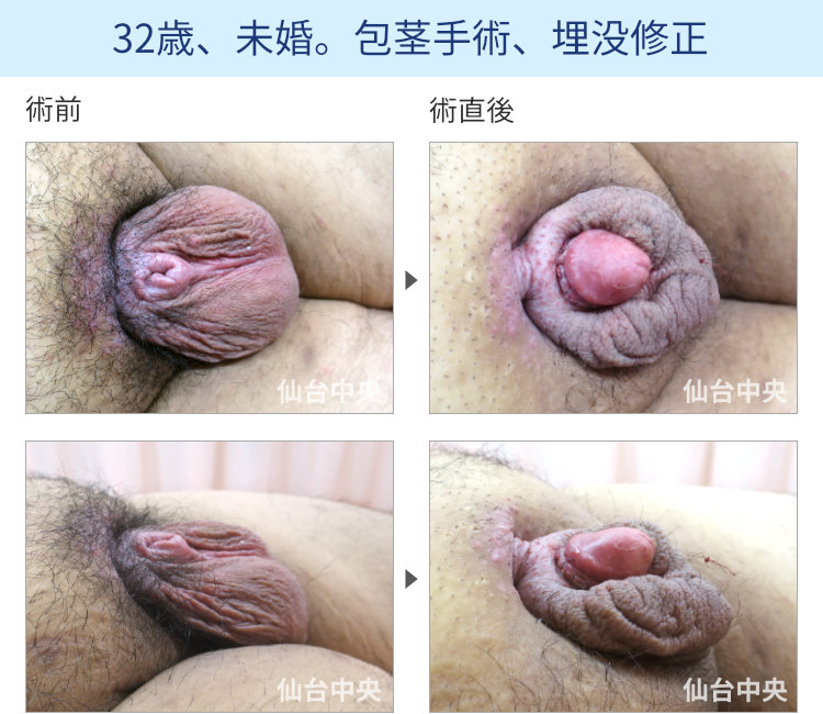 42歳、未婚。包茎手術、埋没修正
