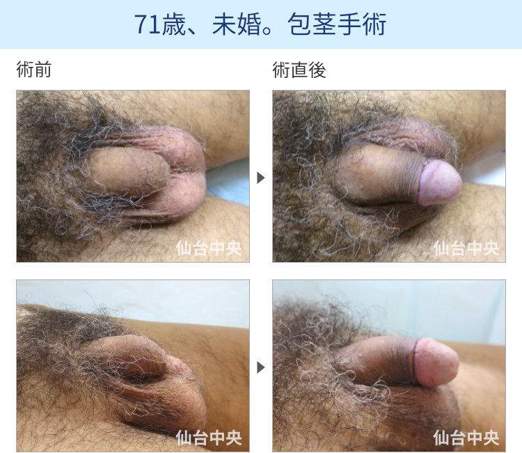 71歳、未婚。包茎手術